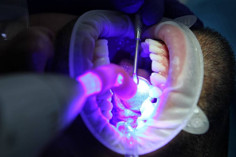 Est-ce que le blanchiment dentaire est dangereux ? Le DR SALLES à Marseille vous répond