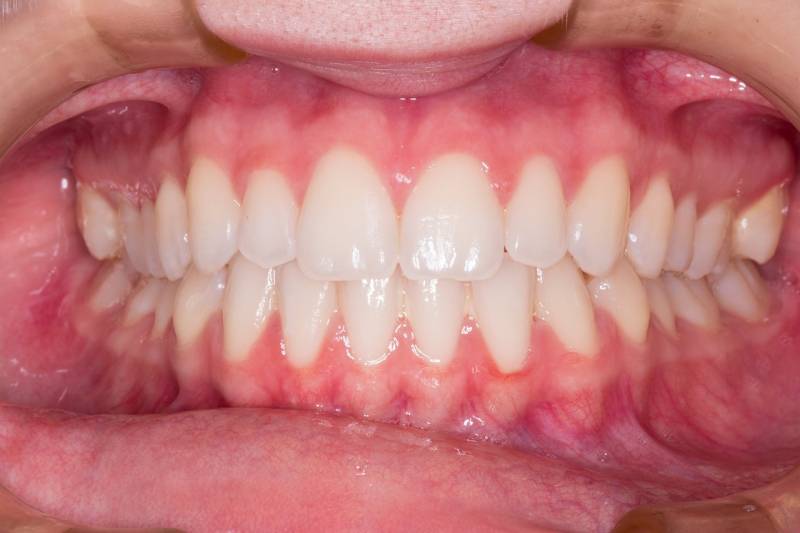 Blanchiment des dents : Bar à sourire ou cabinet dentaire spécialisé ?